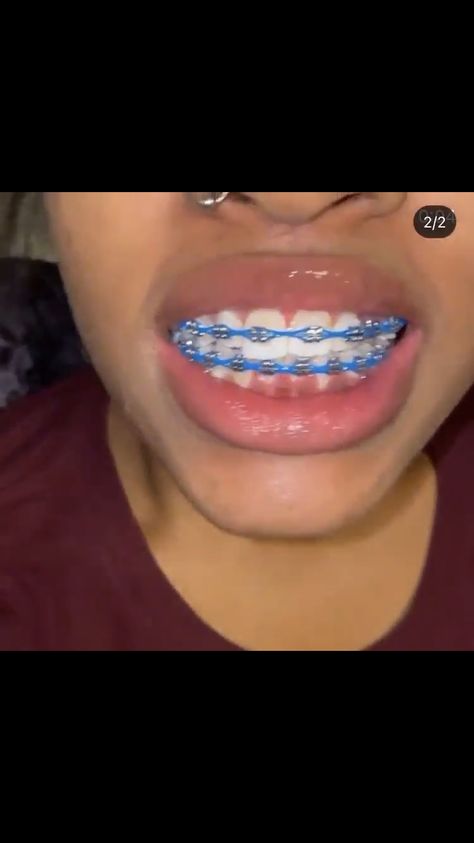 Braces Power Chain Aesthetic, Dark Blue Power Chain Braces, Royal Blue Power Chain Braces, Braces Top Teeth Only, Braces Aesthetic Power Chain, Braces Without Power Chain, Braces Royal Blue, Bright Blue Braces, Red Power Chain Braces