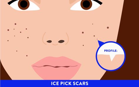 How To Treat Acne Scars | SELF Acne Scar Diy, Longevity Diet, Face Mapping, Natural Acne Remedies, Severe Acne, Inflammation Causes, Types Of Acne, Treat Acne, Acne Problem