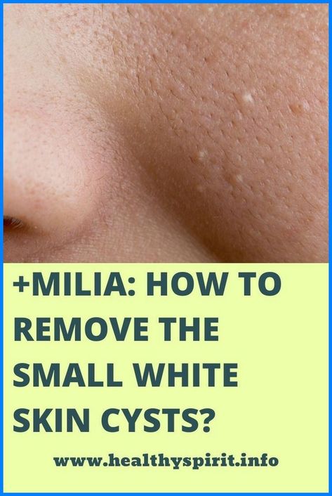 Remove Skin Tags Naturally, Natural Cold Remedies, Cold Home Remedies, Natural Cough Remedies, Cough Remedies, White Skin, Lose 40 Pounds, Natural Home Remedies, Health Advice