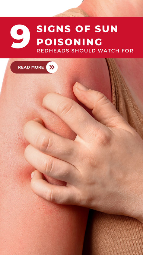 Sun poisoning can be avoided, so it’s important to know what signs/symptoms to look for, how to prevent it, and how to treat it. Sun, Redheads, Sun Poisoning, Summer Tips, Sun Care, Signs And Symptoms, Read More, To Look, Signs