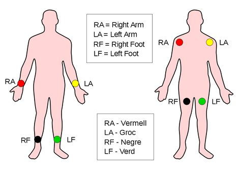 Ekg Lead Placement, Ekg Placement, Lead Placement, Ekg Leads, Medical Quotes, Medical Student Study, Cardiac Nursing, Med School, Student Studying