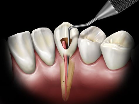 Dental Images, Remedies For Tooth Ache, Dental Posters, Dental Videos, Dental Anatomy, Tooth Pain, Dental Art, Dental Crowns, Dental Procedures