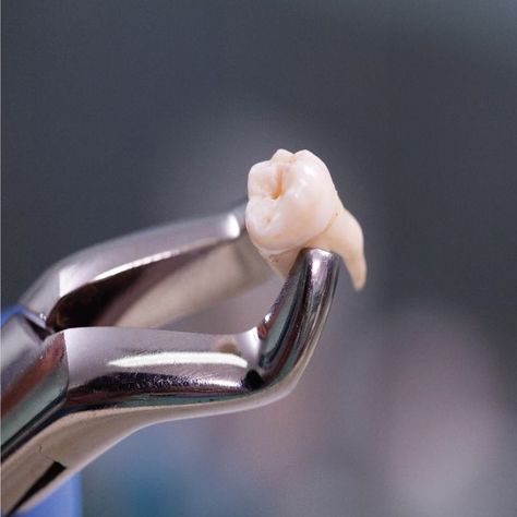 RECENT STUDIES show that a nanoscale view of tooth enamel could lead to a solution for enamel-regenerating tooth treatments! Tooth Extraction Aftercare, Tooth Extraction Healing, Dental Extraction, Sensitive Teeth Remedy, Wisdom Tooth Extraction, Dental Implants Cost, Wisdom Teeth Removal, Tooth Removal, Pediatric Dental