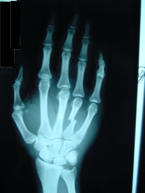 X-Ray Hand Xray, Fractured Arm, Hand Fracture, Baby Feeding Schedule, Mri Scan, Hand Therapy, Danny Phantom, Signs And Symptoms, Radiology