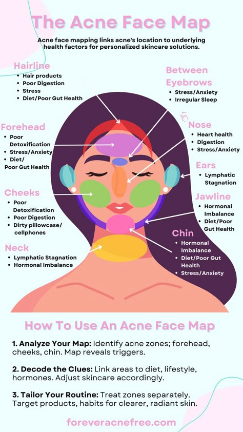 The Acne Face Map, Acne Face Mapping, What Your Breakouts Mean, Acne Solutions Face Map Acne, Acne Chart, Acne Face Mapping, Teen Skincare Routine, Acne Face Map, Face Map, Face Mapping Acne, Forehead Acne, Face Mapping