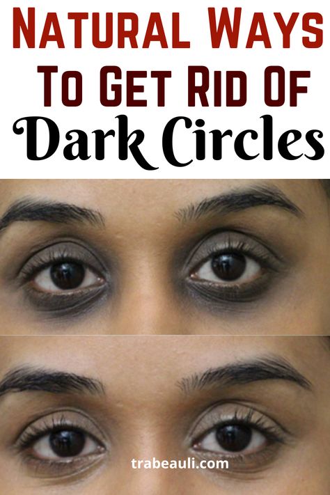 Get rid of dark circles Dark Rings Under Eyes, Darkcircles Skincare, Dark Spots Under Eyes, Dark Circle Remedies, Dark Circles Around Eyes, Hooded Eyelids, Dark Eye Circles, Remove Dark Circles, Dark Circles Under Eyes