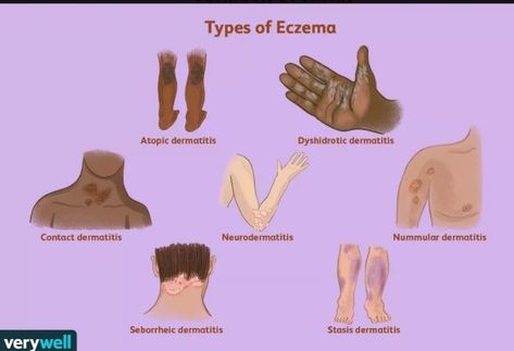 What kind of Eczema do you have? Skin Diseases Types Of, Skin Care For Excema, How To Get Rid Of Excema, Prurigo Nodularis, Ezcema Diet, Illness Remedies, Skin Patches, Medical Studies, Care Care