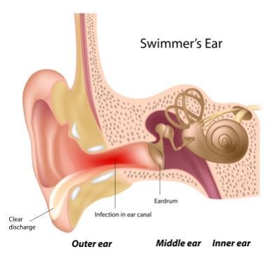 Get rid of an ear infection - 51 Extraordinary Everyday Uses for Hydrogen Peroxide Swimmers Ear Remedy, Cleaning With Peroxide, Swimmers Ear, Middle Ear, Wellness Mama, Diy Cleaning Hacks, Sinus Infection, Hydrogen Peroxide, Essential Oil Recipes