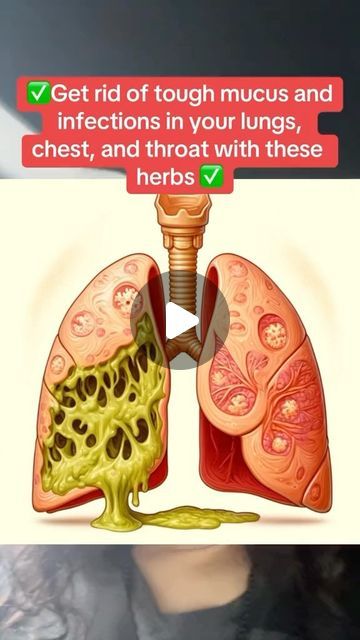 How To Get Mucus Out Of Chest, Remedies For Mucus In Chest, Rid Body Of Mucus, Mucus Cough Remedies, Cold Cough Remedies, Throat Infection Remedy, How To Get Rid Of Phlegm In Throat, Phlegm Remedy Get Rid Of, Chest Congestion Remedies Lungs