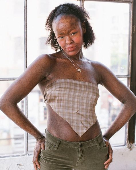 Meet Jeyźa Kaelani, a Model With a Rare Skin Condition Who Proudly Says, “I Am Allowed to Be Beautiful” Models With Freckles, Hair Whorl, Red Hair Freckles, Women With Freckles, Conjoined Twins, Body Features, Glamour Magazine, Skin Condition, Natural Blondes