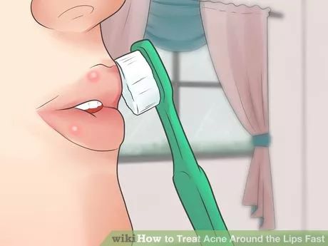 Image titled Treat Acne Around the Lips Fast Step 8 Lip Pimple How To Get Rid Of, Lip Pimple Remedies Overnight, Lip Acne Remedies, How To Get Rid Of Lip Pimples, Lip Acne, Pimples On Lip Line, Pimples Around Lips, How To Hide Pimples, How To Treat Pimples