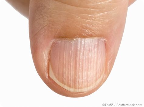 What is Longitudinal Ridging? | News-Medical Fingernail Ridges, Nail Health Signs, Nail Symptoms, Fingernail Health, Nail Ridges, Nail Problems, Health Signs, Lines On Nails, Brittle Nails