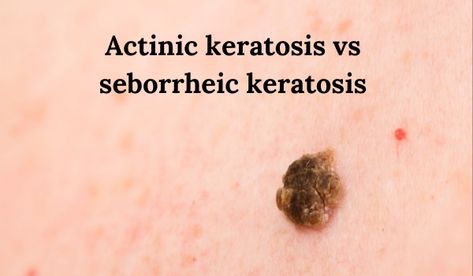 Skin Lesions, Seborrheic Keratosis, Dermatology Office, Basal Cell, Squamous Cell, Skin Growths, Surgery Center, Layers Of Skin, Fair Skin