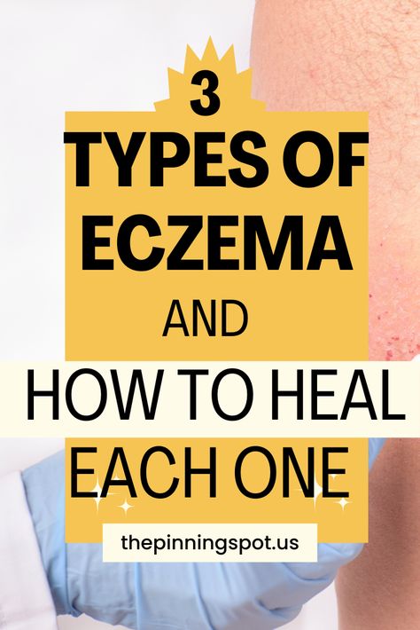 Learn about the different types of eczema & how to heal each one. Whether you're struggling with atopic dermatitis, contact dermatitis, or dyshidrotic eczema, atopic eczema, nummular eczema, or any other type of eczema, this post give you practical tips & remedies tailored to each type of eczema so that you can finally stop dealing with eczema flare-ups, itching, redness & inflammation & finally achieve healthy, glowing skin free from eczema. It's the guide to help you alleviate eczema symptoms How To Heal Excema, Treatments For Excema Natural Remedies, Natural Remedies For Excema, Excema Remedies Diy, Excema Remedies, Excema Relief, Itch Relief Skin, Bath Therapy, Graves Disease