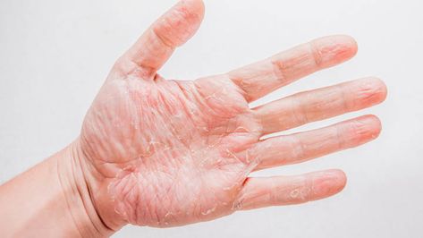 Invigorate your dry peeling hands this summer with these soothing remedies. Will you try this trick? Itch Relief, Bacterial Infection, Peeling Skin, Fungal Infection, Hydroponics System, Flaky Skin, Skin Cream, Skin Conditions, Dead Skin