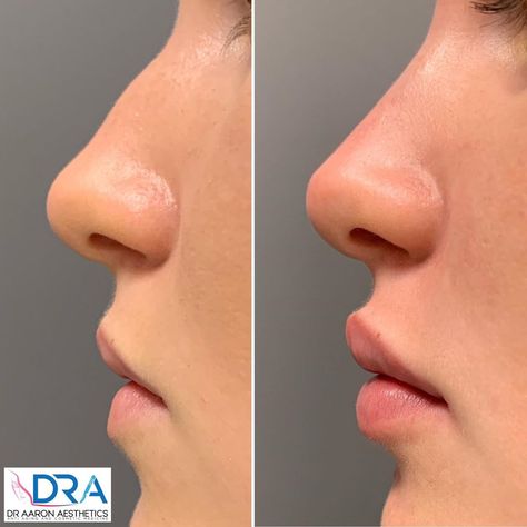 Dr Aaron Stanes on Instagram: “Facial harmonisation using soft tissue dermal filler to this nose, and the lips. Definition, balance, and proportion are achievable with a…” Ideal Nose Rhinoplasty, Nose Tip Lift Botox Before And After, Rhinoplasty Lip Lift, Tip Plasty Nose, Refined Tip Rhinoplasty, Nose Fillers, Rhinoplasty Nose Jobs, Botox Lips, Lips Inspiration