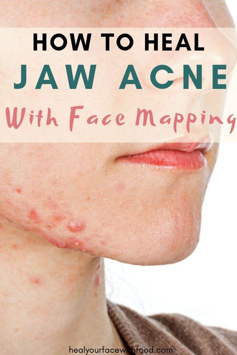 Doterra Acne, Jawline Acne, Neck Acne, Treating Cystic Acne, Chin Acne, Face Mapping Acne, Forehead Acne, Face Mapping, Natural Acne Remedies