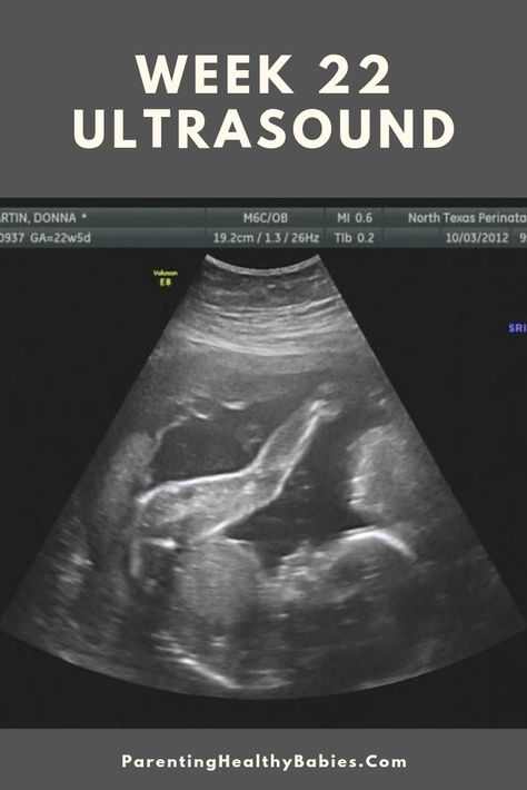 22 Week Ultrasound, 20 Week Ultrasound, Baby Ultrasound Pictures, 22 Weeks Pregnant, Pregnancy Images, Pregnancy Week, Sound Picture, Baby Ultrasound, Ultrasound Pictures