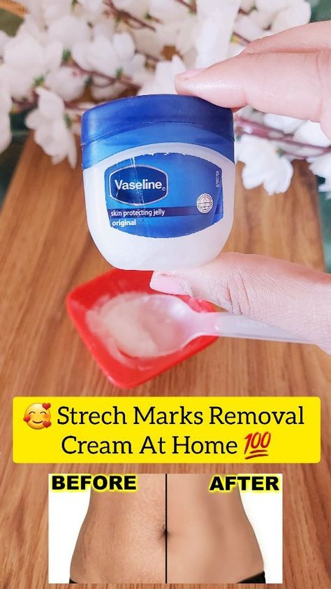 Strech Marks Removal Cream At Home 🏡 . . Ingridents ✅ Vaseline Aloevera gel Vitamin E pill Vitamin A pill Coconut oil . . Follow for… | Instagram