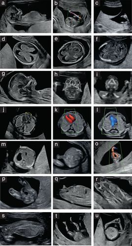 Details are in the caption following the image Nuchal Translucency Ultrasound, Diagnostic Medical Sonography Student, Baby Ultrasound Pictures, Ultrasound School, Ultrasound Physics, Obstetric Ultrasound, Sonography Student, Ultrasound Sonography, Radiology Student