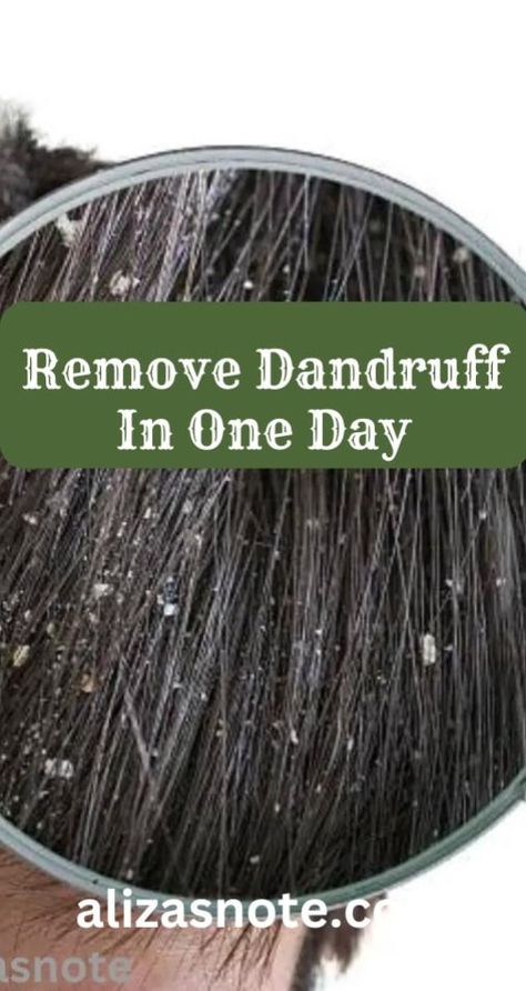 Remove Dandruff In One Day How To Remove Dandruff, Hair Growth Mask Diy, Severe Dandruff, Apple Cider Vinegar Hair Rinse, Dandruff Solutions, Home Remedies For Dandruff, Vinegar For Hair, Rid Of Dandruff, Apple Cider Vinegar For Hair