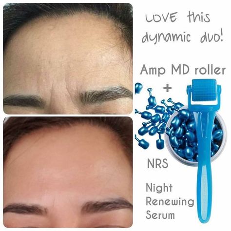 Frown Lines Between Eyes, Frown Wrinkles, Roden And Fields, Under Eye Primer, Botox Lips, Frown Lines, Micro Needling, Rodan And Fields Redefine, Botox Alternative