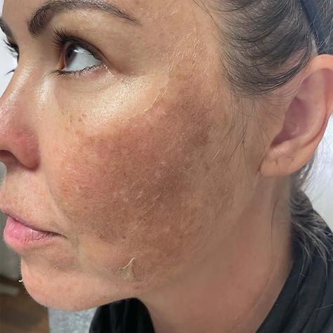 My Skin Looks Worse After Chemical Peel - Is That Normal? Facial Chemical Peel Before And After, Perfect Derma Peel Before And After, Chemical Peel Aesthetic, Chemical Peel Before And After, Botox Business, Chemical Peel Results, Chemical Face Peel, Skincare Marketing, Peeling Face