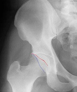 Labrum Tear Hip Recovery, Labrum Tear Hip Exercise, Torn Labrum Hip Exercises, Femoroacetabular Impingement, Labral Tear Hip, Labral Tear Shoulder, Knee Meniscus, Torn Labrum, Hip Anatomy