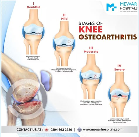 There are 4 stages of Knee Osteoarthritis Minor - 1 stage means you got some wear in your knee joint Mild - 2 stage is when you might start to feel pain and stiffness Moderate – 3 Stage if you’re at the moderate stage, you’ll have more pain, especially when running, walking, squatting, and kneeling Severe – 4 Stage Severe osteoarthritis means that the cartilage is almost gone. For more Information Contact Us on : 0294 663 3330 #mewarhospitals #kneesurgery #knee #kneepain #osteoarthritis #joi Spine Surgery, Knee Exercises, Knee Surgery, Knee Pain, Surgery, More Information, Walking, Contact Us, Running