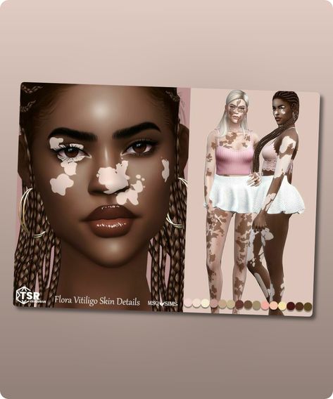 Sims 4 Skins / Skindetail CC: Flora Vitiligo Skin Details By Msqsims Sims Body Overlay Cc, Sims 4 Cc Vitíligo Skin, Sims 4 Vitíligo Skin Cc, Sims 4 Vitíligo Cc, Sims 4 Skins, Sims Skins, Sims 4 Cc Download, Skin Details, Sims 4 Cc Skin