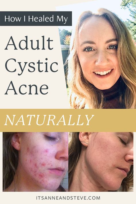 How I Cleared My Adult Cystic Acne Naturally By Trusting My Body How To Get Rid Of Cystic Acne, Back Acne Remedies, Cystic Acne Remedies, Acne Diet, Acne Products, Bad Acne, Acne Overnight, Acne Skincare Routine, Natural Acne Remedies