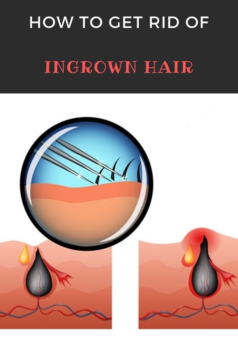 They itch, hurt and look unattractive: ingrown hair. But how can you prevent them and what helps once they are there? And can they really lead to blood poisoning? How To Get Rid Of Ingrown Hairs On Vag, Ingrown Pimple, Ingrowing Hair, Ingrown Hair Armpit, Creative Senior Picture Ideas, Treat Ingrown Hair, Ingrown Hair Remedies, Bump Hairstyles, Chin Hair