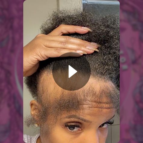 Fixing Edges Hairstyles To Protect Edges, Bald Edges Hairstyles Black Women, Protective Styles For Thinning Edges, Braids For Thinning Edges, No Edges Hairstyles Black Women, Regrow Edges, Edges Hairstyles, Dramatic Edges, Thinning Edges