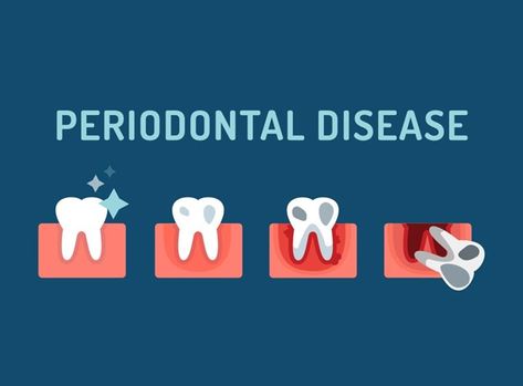 https://www.arlingtondentalteam.com/the-stages-of-periodontal-disease-and-their-symptoms/amp/ Teeth Diseases, Partial Dentures, Dentist Appointment, Restorative Dentistry, Family Dentist, Periodontal Disease, Arlington Va, Natural Teeth, Dentures