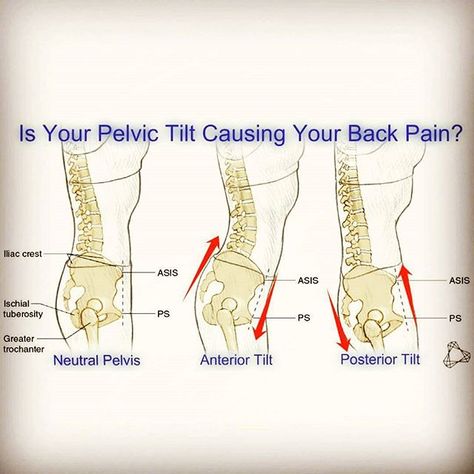 If your #pelvis is stuck in an Anterior or Posterior Tilt... It may be the cause of your #Back #Pain  An Anterior Pelvic Tilt is when the front of your pelvis drops down ⏬ and the back of the pelvis comes up ⏫and this creates an increased curve in your low back . A Posterior Pelvic Tilt is when the back of the pelvis comes down and tucks under and the front of the pelvis comes up creating a flat spine in the lo... Posterior Pelvic Tilt, Anterior Pelvic Tilt, Physiotherapy Exercises, Pelvic Tilt, Guided Imagery, Yoga Anatomy, Spine Health, Muscle Anatomy, Body Condition