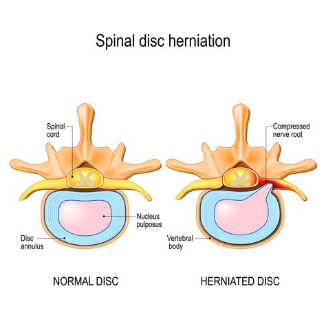 Cervical Disc, Disc Herniation, Lumbar Disc, Intervertebral Disc, Spinal Column, Bulging Disc, Disk Herniation, Spinal Nerve, Rare Occasions