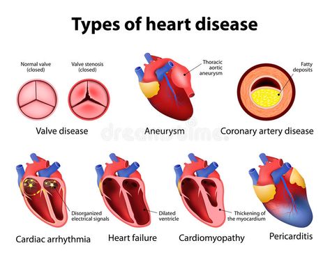 Types Of Heart, Diet Schedule, Cardiac Nursing, Coronary Arteries, Heart Conditions, Medical Knowledge, Cardiology, Cardiovascular Disease, Heart Health