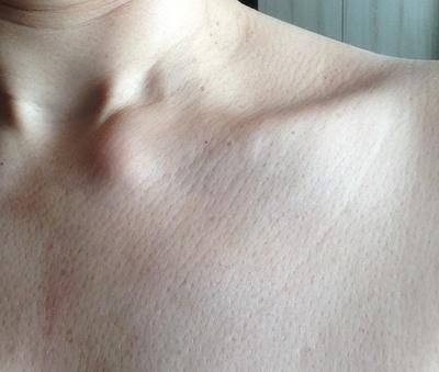 A swollen sterno clavicular joint is usually Tietze's syndrome. I have had a hard lump on my collar bone near my throat, swollen collar bones & sternum How To Get Collar Bones, Collar Bone Exercise, Lee Fletcher, Clavicle Bone, Beauty Bone, Lump In Throat, Torso Anatomy, Neck Bone, Bone Fracture