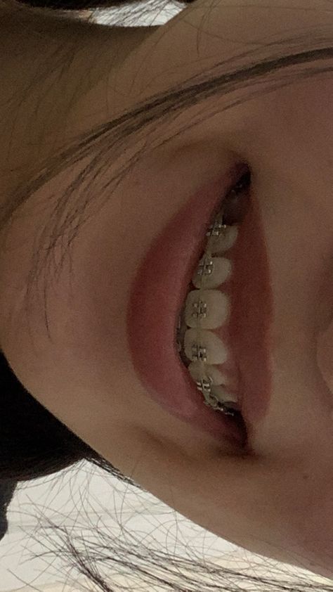 White Teeth Braces, Straight Teeth Braces, Braces Vision Board, Braces Smile Aesthetic, Burgundy Braces Color, Silver Braces Aesthetic, Good Teeth Aesthetic, Straight Teeth With Braces, Brace Aesthetics