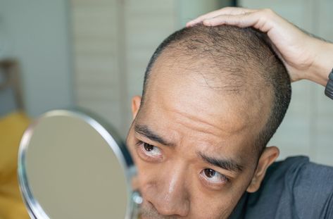 Which Vitamin Deficiency Causes Hair Loss? Zinc Deficiency, Androgenetic Alopecia, Hair Growth Cycle, Vitamin Deficiency, Hair Growth Supplement, Hair Shedding, Scalp Conditions, Thinning Hair, Roots Hair