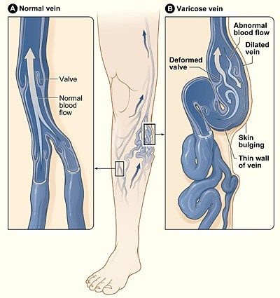 How to Prevent Varicose Veins Home Remedies For Spiders, Varicose Vein Remedy, Venous Insufficiency, Stubborn Belly Fat, Cider Vinegar, Health Remedies, Apple Cider, Budapest, Home Remedies