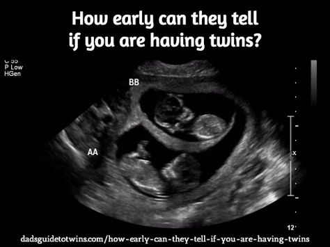 How early can they tell if you are having twins? Here are typical experiences: http://www.dadsguidetotwins.com/how-early-can-they-tell-if-you-are-having-twins/ Ultrasound Pictures 8 Weeks, 7 Weeks Pregnant Ultrasound, 7 Week Ultrasound, Twins Ultrasound, 4 Weeks Pregnant, 7 Weeks Pregnant, Pregnancy Ultrasound, 4d Ultrasound, Having Twins