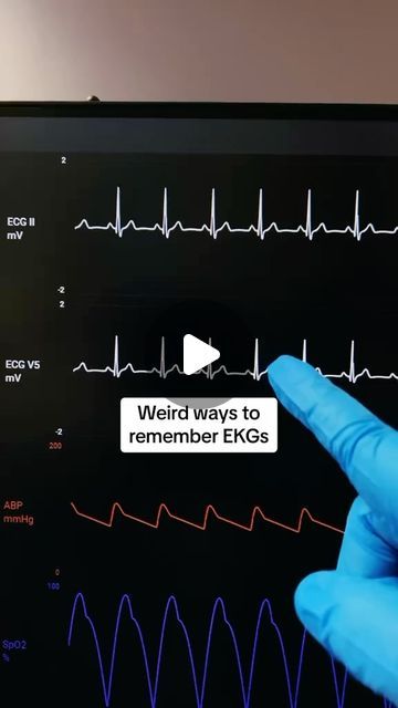 Amanda Draayer on Instagram: "EKGs Made Ridiculously Simple 🫀 👉Truth: Let’s be honest when we all first saw different EKGs, they just looked like squiggly lines. It used to feel impossible for me to interpret an EKG. Let me show you an easier way. A Normal Sinus Rhythm EKG has: 1️⃣ Spike that looks like a SAILBOAT ⛵ = QRS complex 2️⃣ 2 waves between each ⛵ = P wave + T wave 3️⃣ 60-100 BPM SINUS TACHYCARDIA = Spike ⛵ + 2 waves that come fast together. >100 BPM SINUS BRADYCARDIA = Spike ⛵ + 2 waves that are slowed apart. <60 BPM AFIB = Spike ⛵ + choppy or chaotic waves pattern on repeat AFLUTTER = Spike ⛵ + waves cut w/ a sawtooth 🪚 VTACH = Mountains of HUGE waves. 🌊🌊🌊 VTACH w/ pulse = cardiovert, VTACH w/o pulse = defibrillate VFIB = Pure chaos of waves w/ no spike ⛵. Have the V (V Nursing School Studying Cheat Sheets, Sinus Rhythm, Med School Study, Nurse Skills, Normal Sinus Rhythm, Squiggly Lines, P Wave, Nursing School Essential, Nursing School Motivation