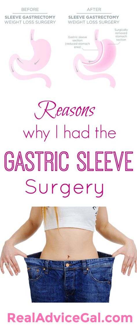 Why I had the Gastric Sleeve Surgery Gastric Surgery, Surgery Quotes, Vsg Surgery, Vertical Sleeve Gastrectomy, Bariatric Sleeve, Bariatric Food, Sleeve Gastrectomy, Bariatric Diet, Sleeve Surgery