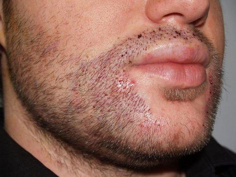 Beard Transplant: Should You Do It? (What You Need to Know) Hair Surgery, Beard Transplant, Hair Implants, Facial Hair Growth, Patchy Beard, Hair Transplant Procedure, Natural Beard, Beard Styles Short, Male Pattern Baldness