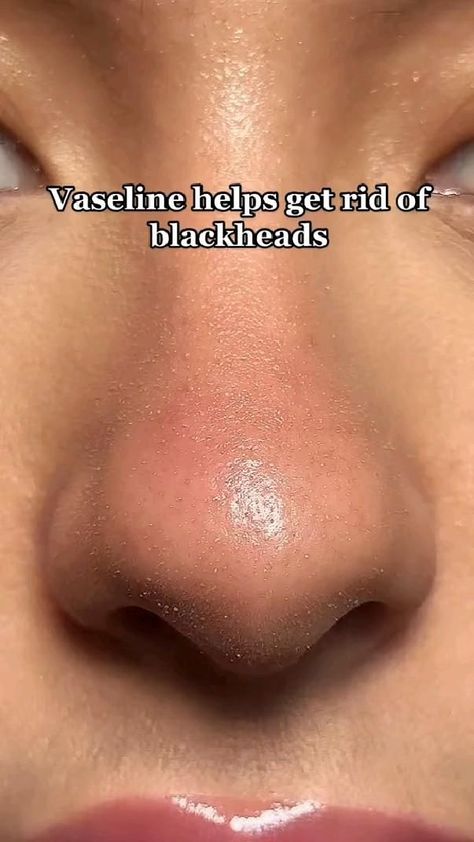 how to get rid of blackheads ✨ Blind Pimple, Blackheads On Nose, Rid Of Blackheads, How To Get Rid Of Pimples, Perfect Skin Care Routine, Get Rid Of Blackheads, Body Skin Care Routine, Face Skin Care, Skin Tips