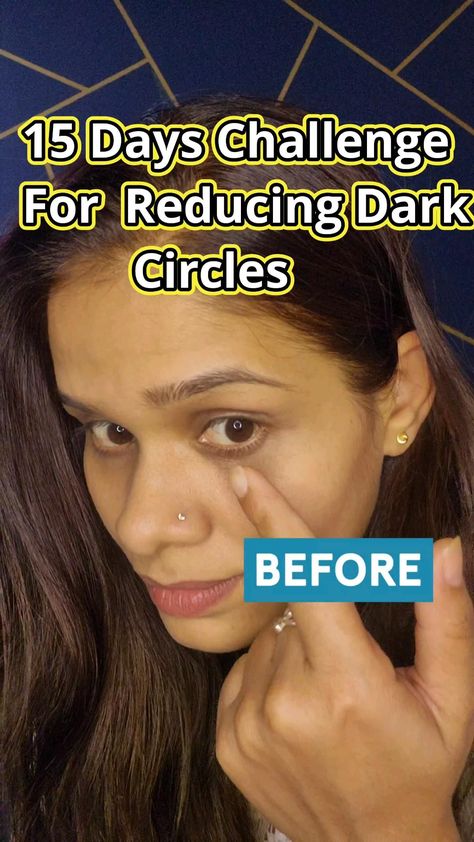 💪🏻15 Day Challenge for Under Eye Dark Circle Reduction Potato and Honey #shorts #darkcircles Eye Bag Remedies, Dark Circles Around Eyes, Dark Circle Remedies, Honey Beauty, Dry Skincare, 15 Day Challenge, Dark Eye Circles, Natural Face Skin Care, Good Skin Tips