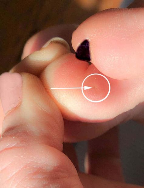 Plantars Wart Remedy, How To Get Rid Of Warts On Feet Fast, Diy Wart Removal Fast, Plantar Wart Removal Videos, How To Get Rid Of Warts On Hands, Plantar Warts How To Get Rid Of, Planters Warts On Foot, Warts How To Get Rid Of, Wort Removal