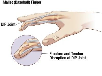 What is mallet finger, and how can you treat it? From Oh My Arthritis Finger Illustration, Nbcot Exam, Anatomy 101, Carpel Tunnel, Mallet Finger, Physical Therapy School, Finger Injury, Emotion Chart, Types Of Surgery