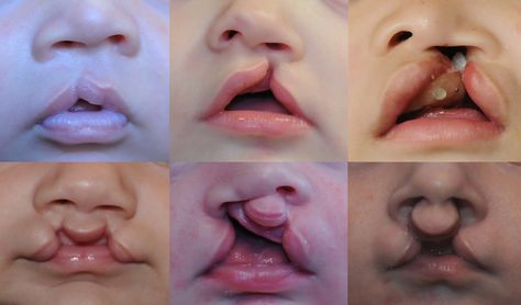 Cleft Lip And Palate, Cleft Palate, Facial Surgery, Cleft Lip, Facial Plastic Surgery, Facial Plastic, Body Anatomy, Arte Sketchbook, Ap Art